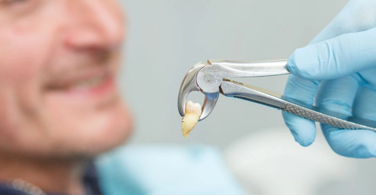 Smoking After Tooth Extraction Inblog